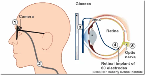 Funcionamiento del ojo biónico Argus II Diagrama del funcionamiento de las gafas y el implante retinal Argus II
